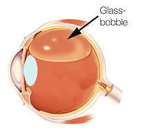 Netthinneavløsning: Pneumatisk retinopeksi (glassboble)