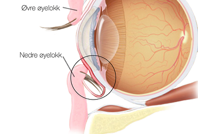 Øyelokk og behandlinger: Entropion