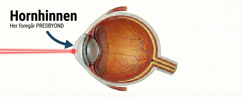 Illustrasjon som viser at Presbyond-laser foreg&aring;r i hornhinnen