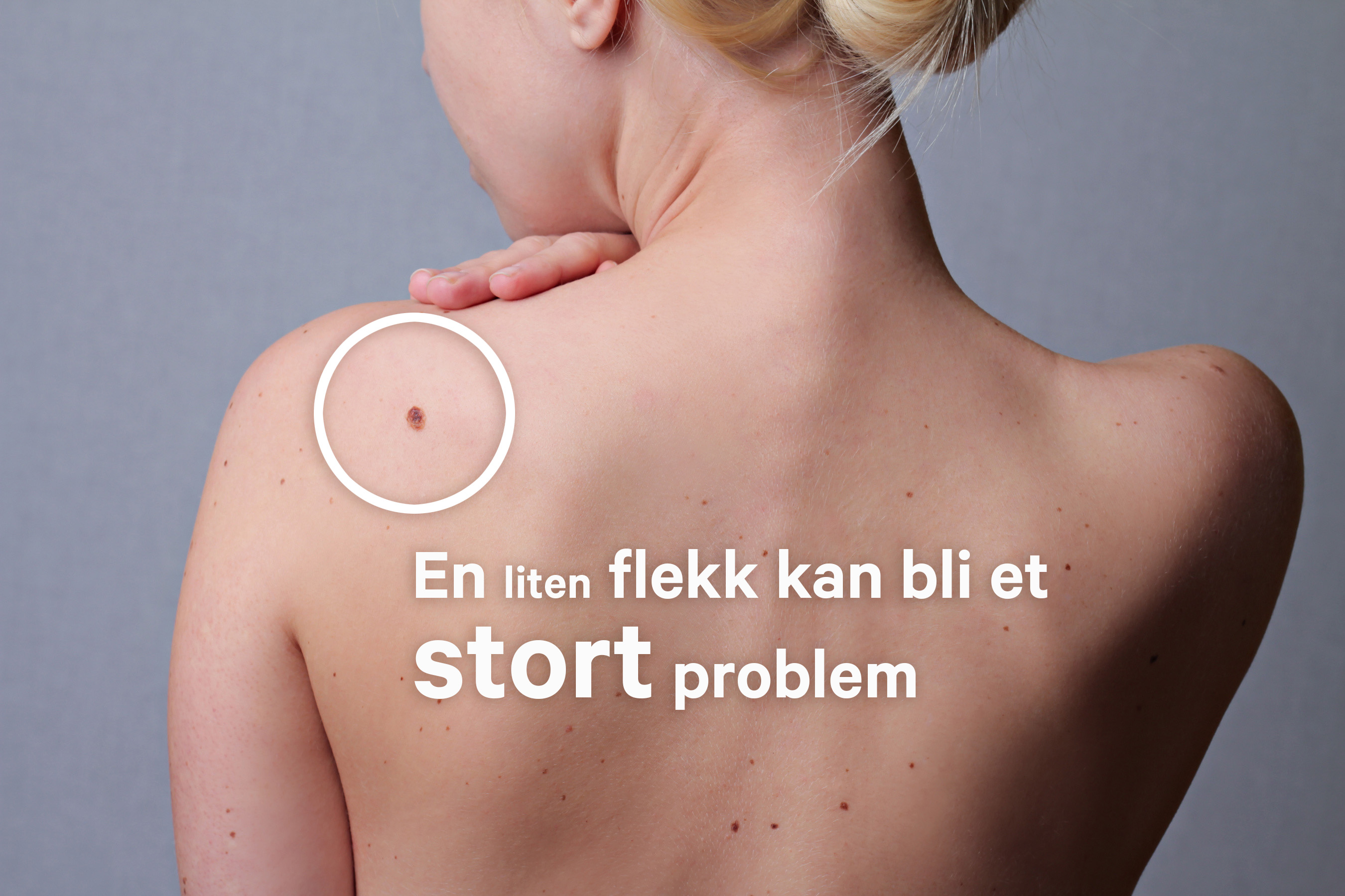 Hudkreftdagen 27. mai 2020