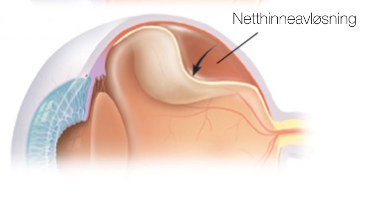 Figur: Netthinneavløsning