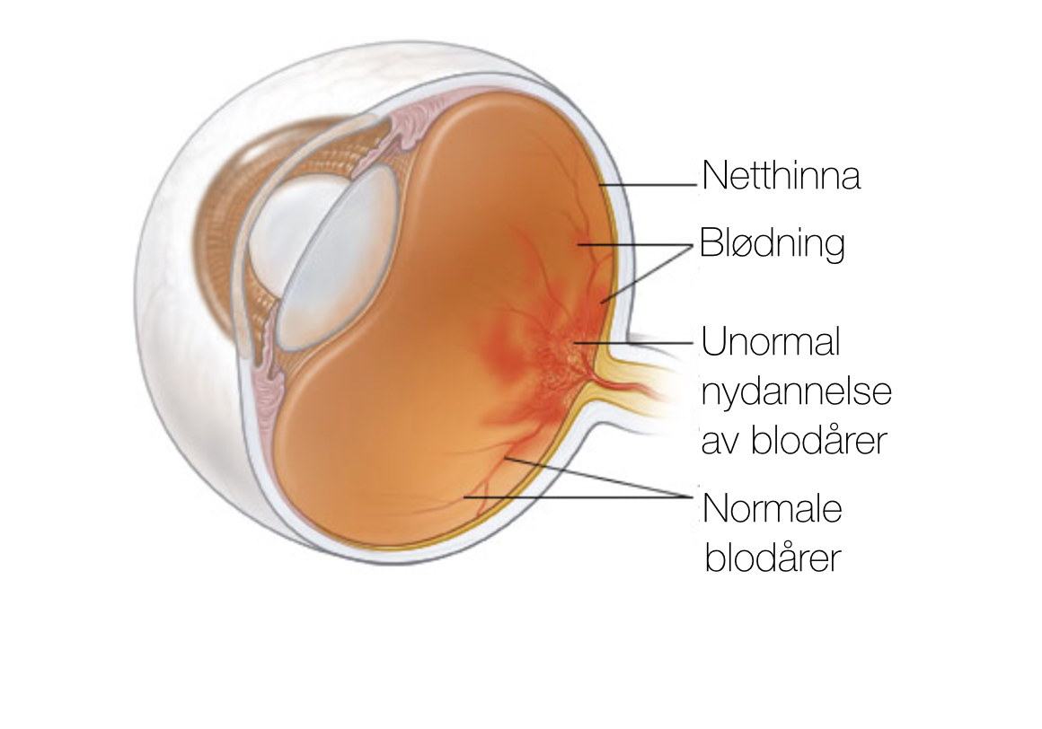 Figur: Diabetes retinopati