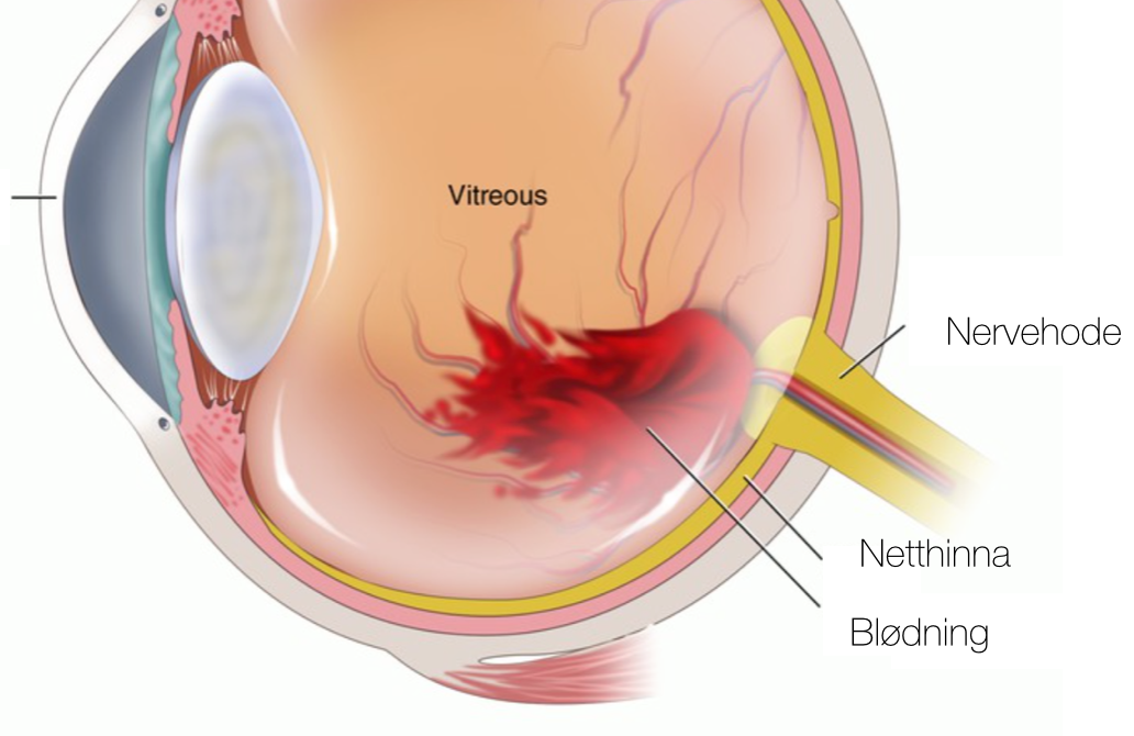 Figur: Vitreus blødninger