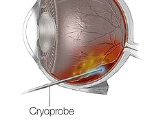 Netthinneavløsning: Cryopexy