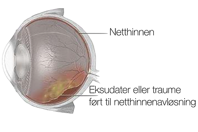 Netthinneavløsning: Eksudative 