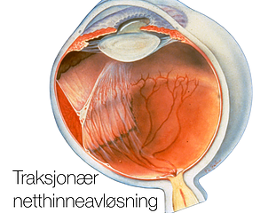 Netthinneavløsning: Traksjonær 
