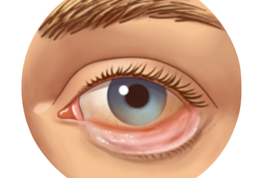 Øyelokk og behandlinger: Ektropion
