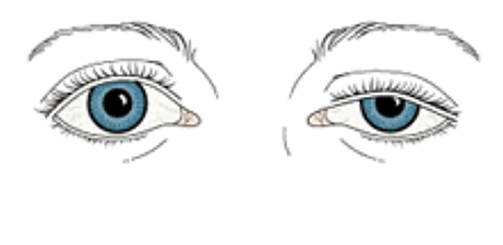 Øyelokk og behandlinger: Ptose