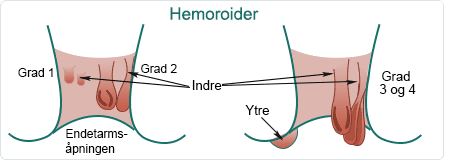 Hemoroider