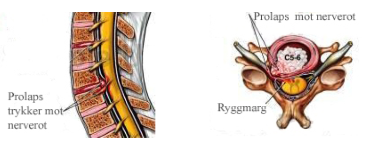 Prolaps i nakken sykemelding