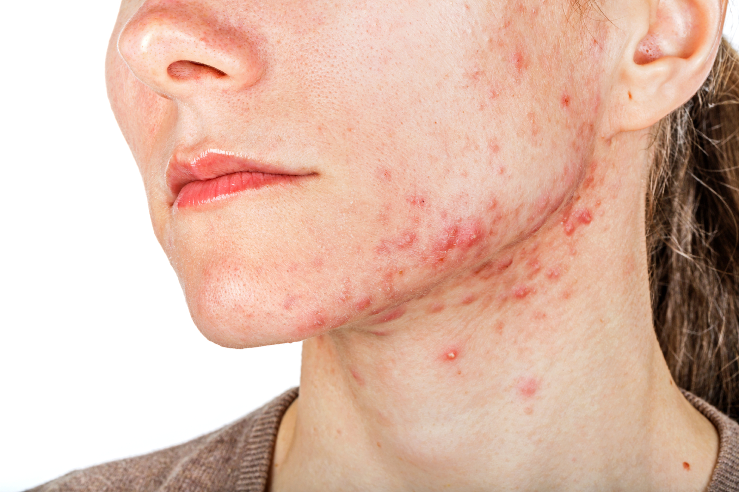 Behandling av kviser (acne)